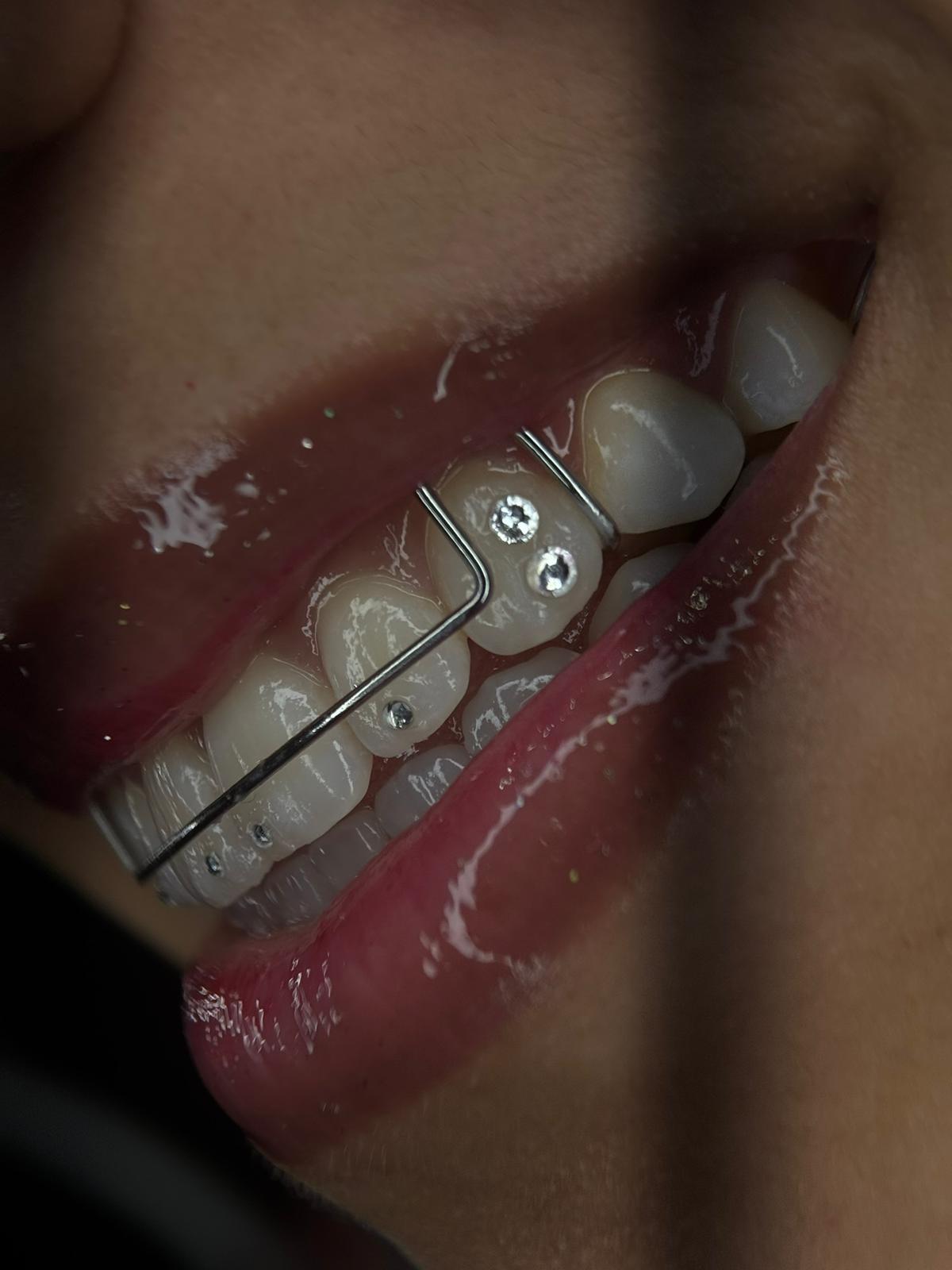 Candidata para gemas dentales