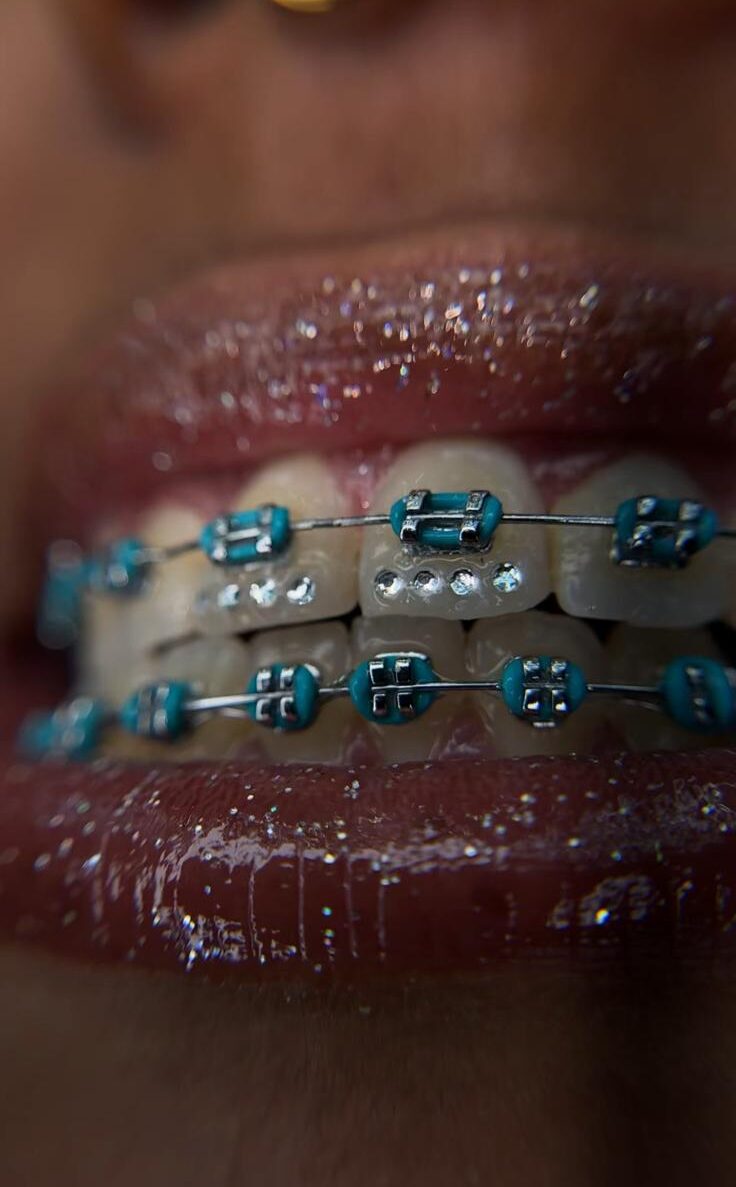 Ejemplo de aplicación de gemas dentales