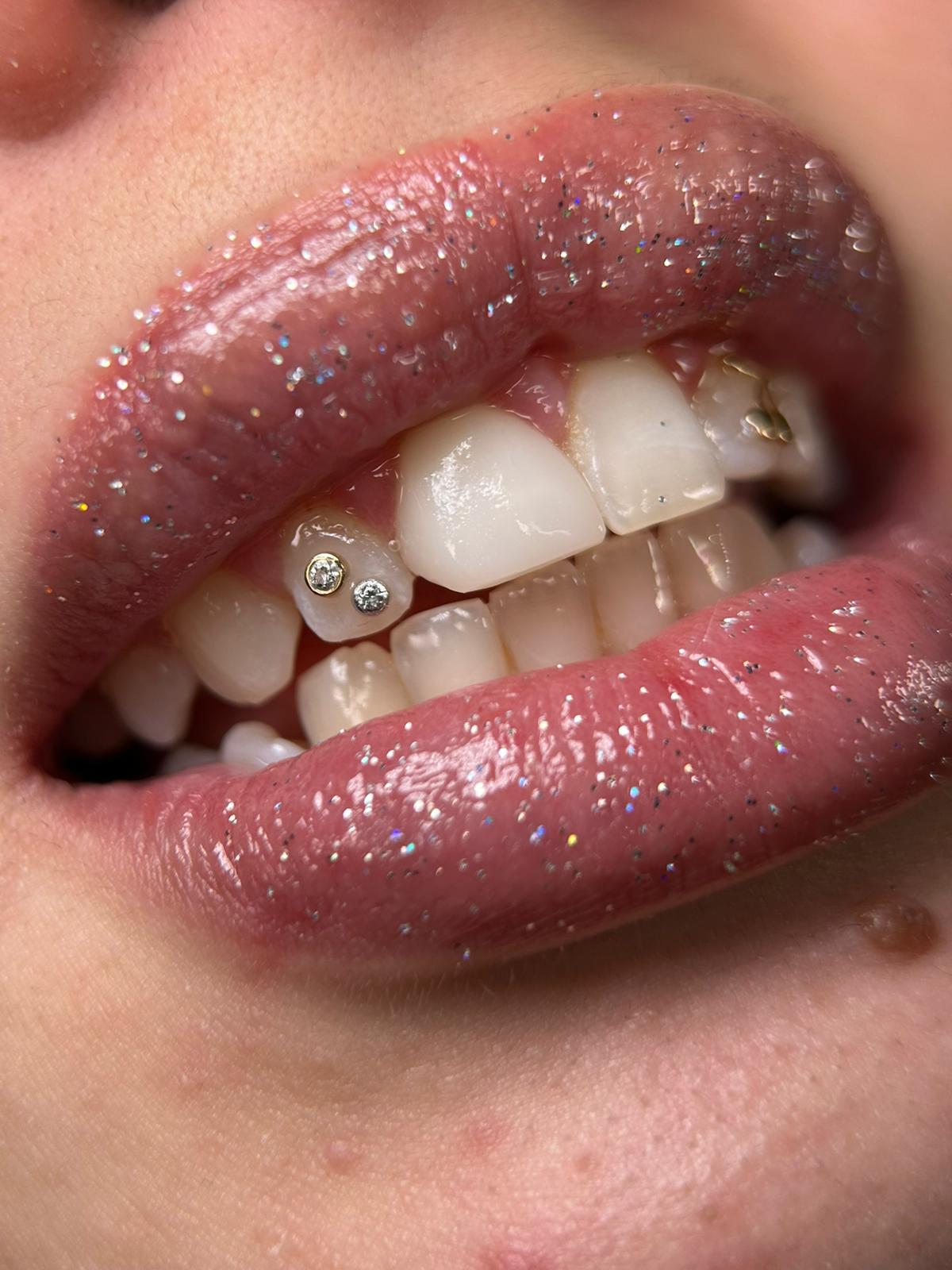Diamantes dentales