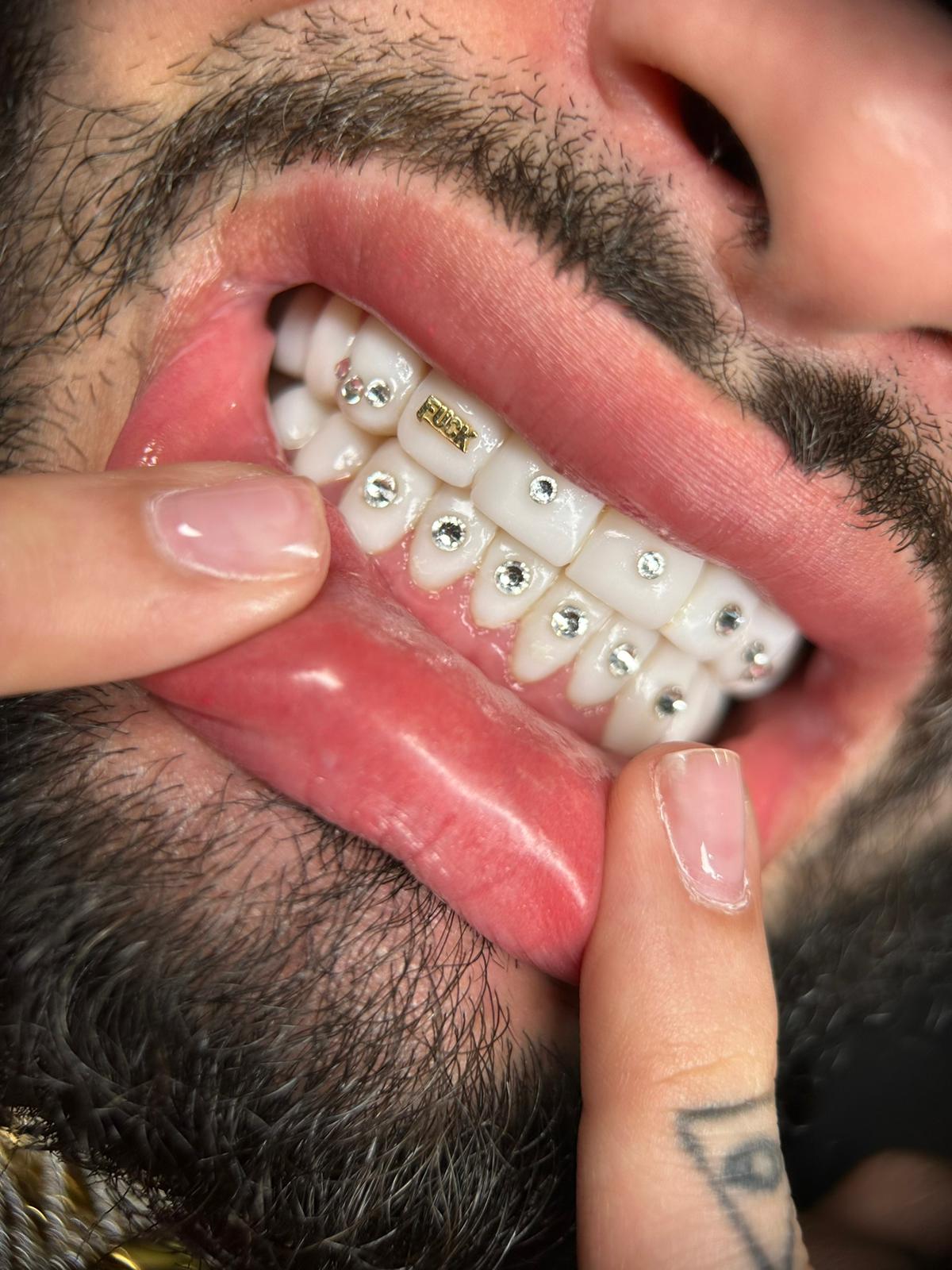 Set de gemas dentales
