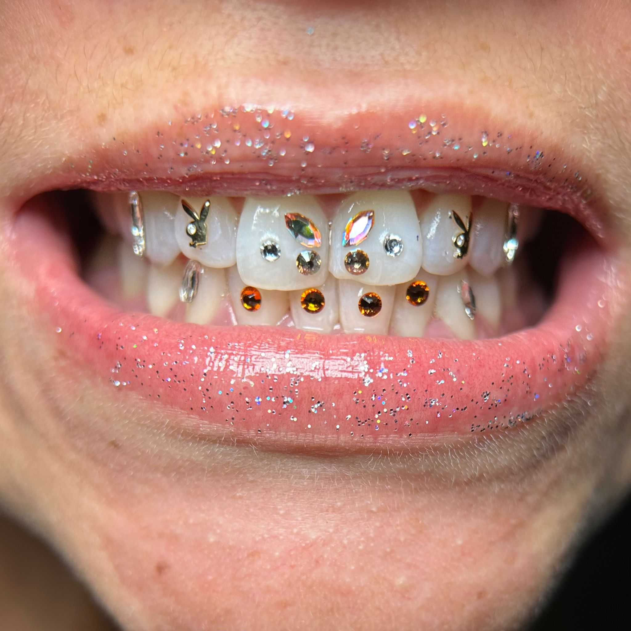 Diseño personalizado de gemas dentales